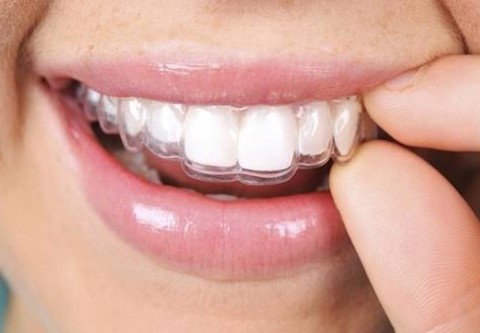 Niềng răng vô hình có tốt không?