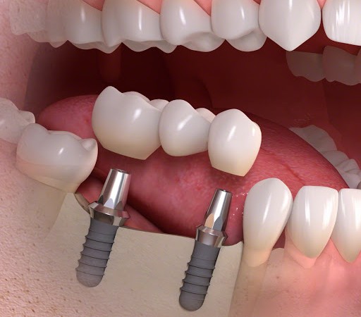 Sau Khi Nhổ Răng Có Cấy Ghép Implant Ngay Được Không?